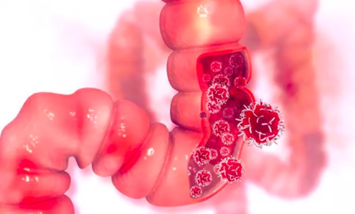 Hábito alimentar comum no Brasil está ligado à incidência de câncer no intestino, aponta estudo