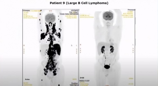 Associada a uma vacina, terapia elimina até 80% de tumores sólidos