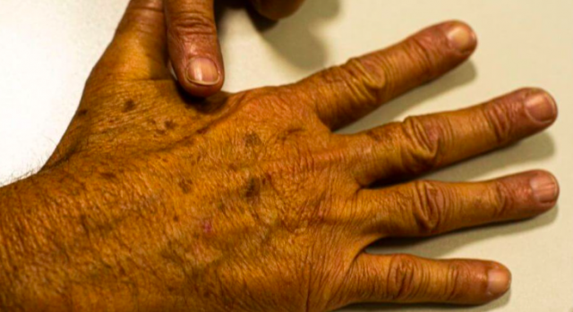 Pacientes do SUS terão acesso a tecnologia inovadora para tratamento de câncer de pele