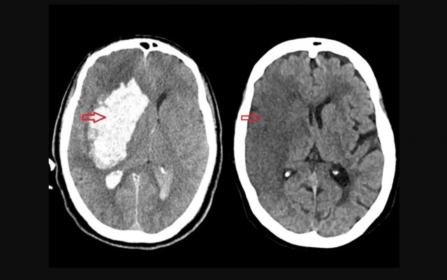 Brasil perde uma vida a cada seis minutos por AVC, mas maioria dos casos é evitável