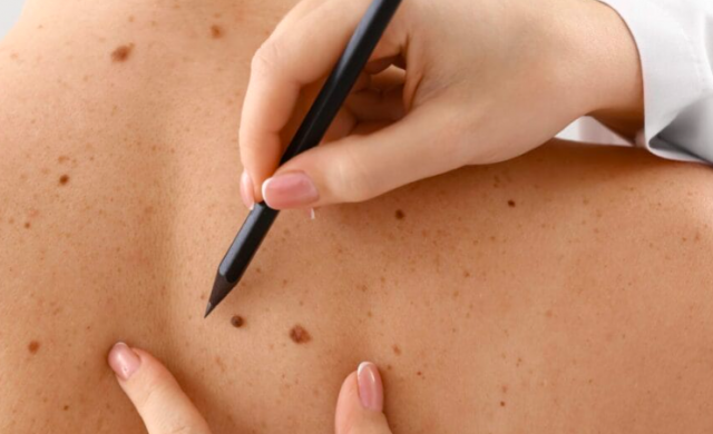 Região Sul do Brasil tem 150 casos de câncer de pele para cada 100 mil habitantes, revela Inca