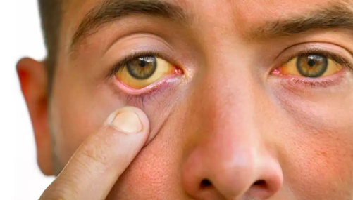 Hepatites podem levar a câncer no fígado e SC tem ‘boom’ com 1,5 mil novos casos