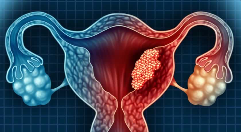 Conheça mais sobre a Endometriose