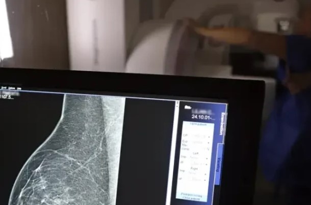 ANS propõe aumentar para 50 anos a idade mínima para mamografia