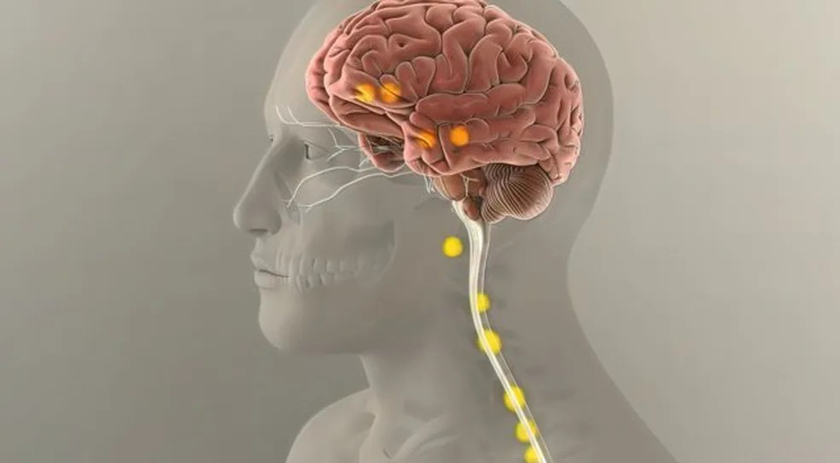 Alzheimer: Anvisa aprova tratamento inédito para doença no país; entenda