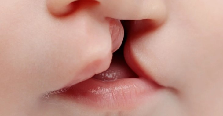 SUS passa a oferecer cirurgia de lábio leporino e tratamento completo pelo sistema público