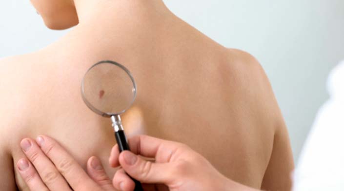 Número de mortes por câncer de pele ultrapassa 260 pessoas em SC