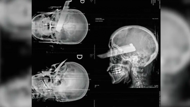 Mulher tem faca cravada no olho em tentativa de feminicídio no Oeste de SC