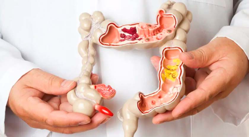 SC terá cerca de 2,5 mil novos casos de câncer de intestino em 2023, prevê Inca