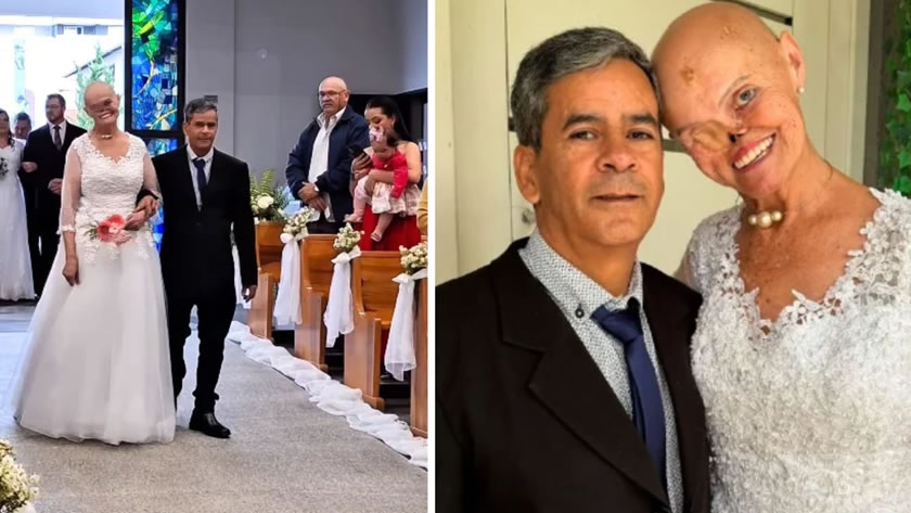 Catarinense que enfrentou 73 cânceres de pele se casa com homem que conheceu durante rotina de exames em hospital de SC