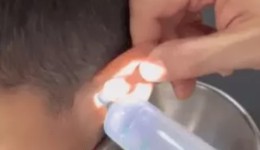 Médico remove do ouvido de uma criança três caroços, um talo de uva e uma barata